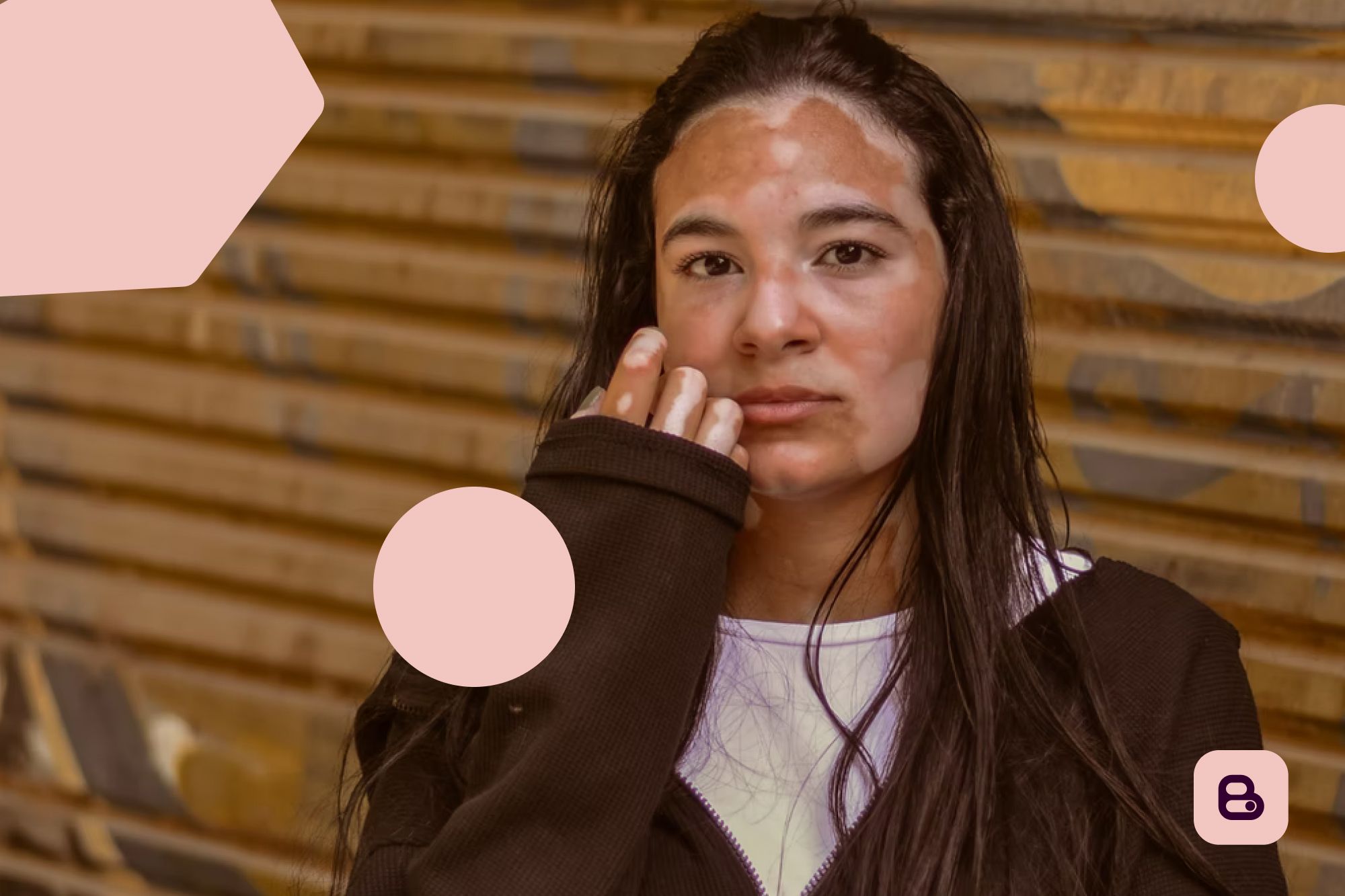 Mulher com lesões de vitiligo no rosto, pescoço e mãos. Ela veste casaco preto e camiseta branca. Há formas geométricas e a l